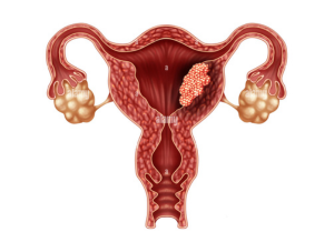 T/t of endometrial, cervical and ovarian cancers