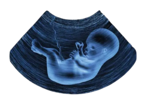 ultrasounds- viability scan, nt nb scan, anomaly scan & growth scan with doppler